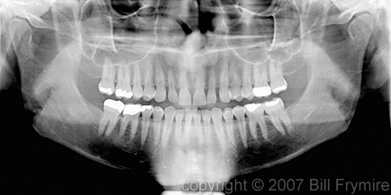 panoramic dental x-ray