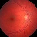 back of an eyeball showing optic nerve